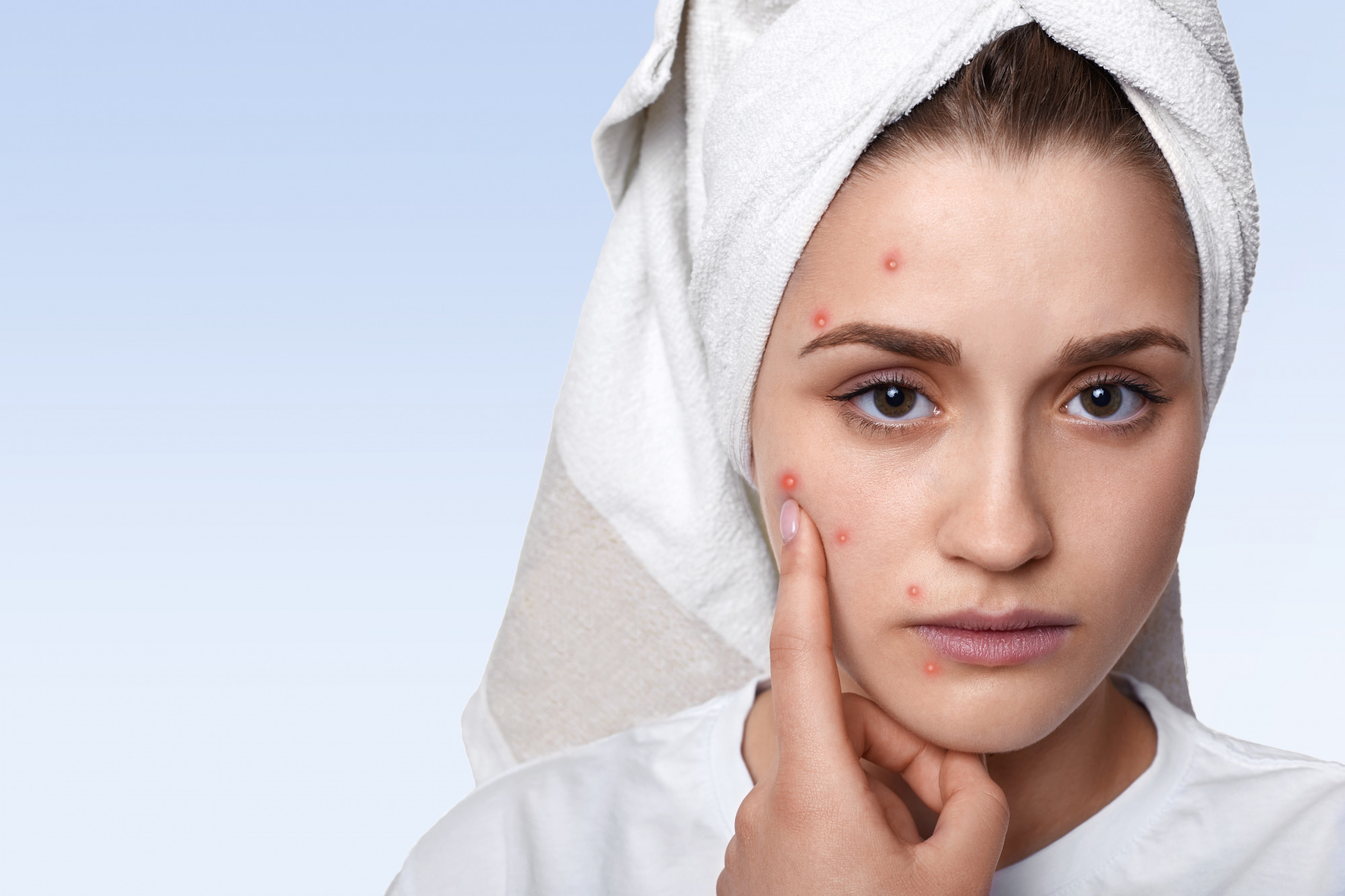 Portrait of a woman with pimples on her face. 